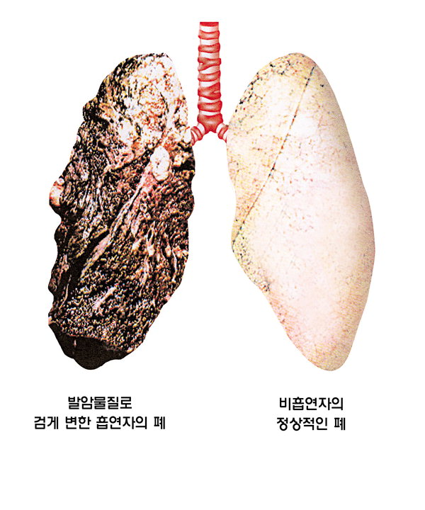 [건강] 폐암 걸렸다 싶으면 때는 늦다