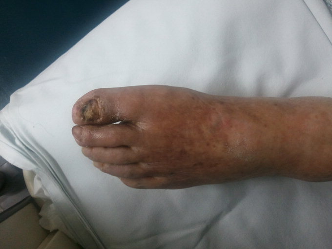 발톱 깎다 생긴 상처 쉽게 보지 마세요