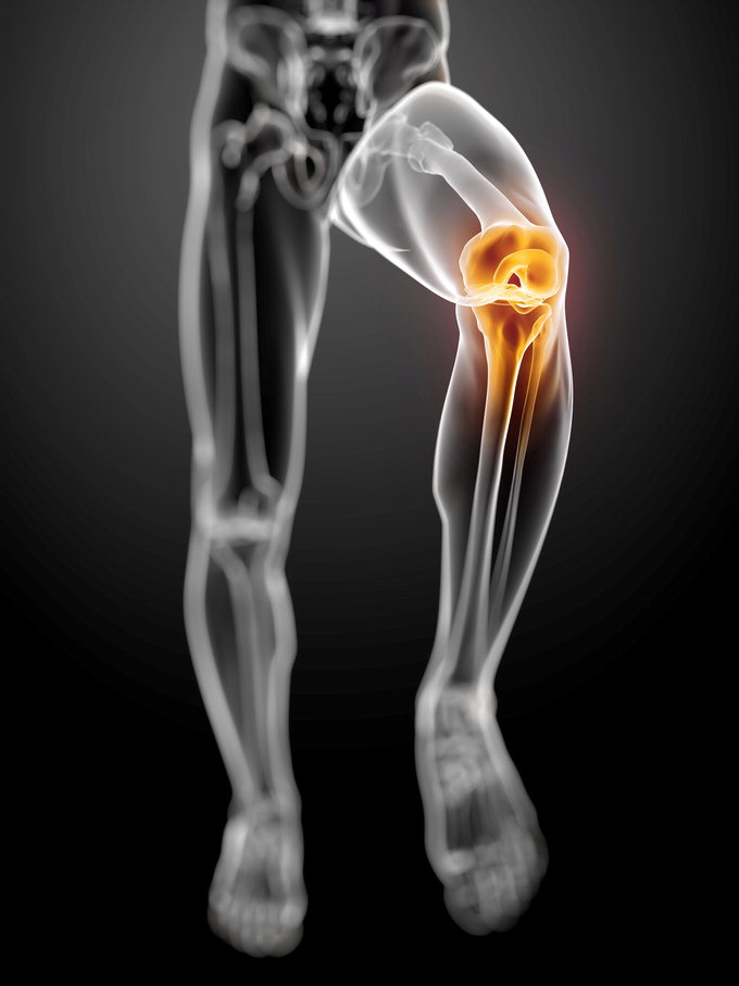무릎 관절염, 수술 이전에 운동·약물치료 더 중요하다