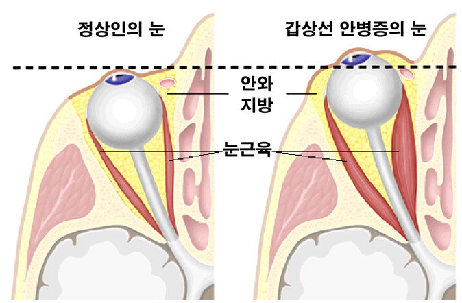 [전문의에게 듣는다] 갑상선 안병증