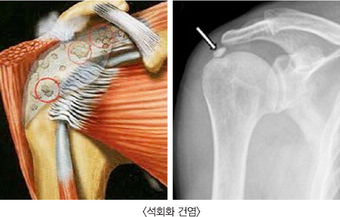 [전문의에게 듣는다] 견관절 질환