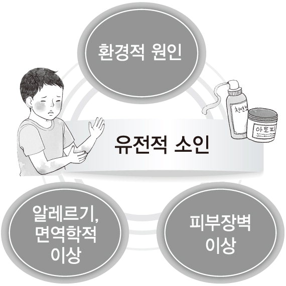 [전문의에게 묻는다] 얄미운 불청객, 아토피피부염