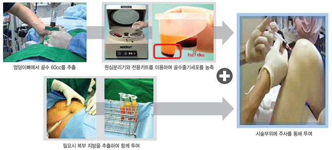 줄기세포로 연골 재생…퇴행성관절염 수술없이 완치