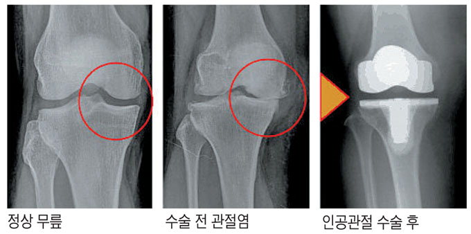 줄기세포로 연골 재생…퇴행성관절염 수술없이 완치