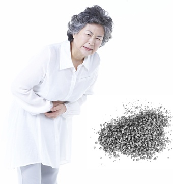 [전문의에게 듣는다] 담석증