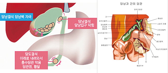 [전문의에게 듣는다] 담낭결석 치료 방법