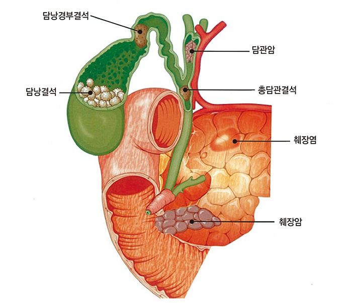 [전문의에게 듣는다] 담석