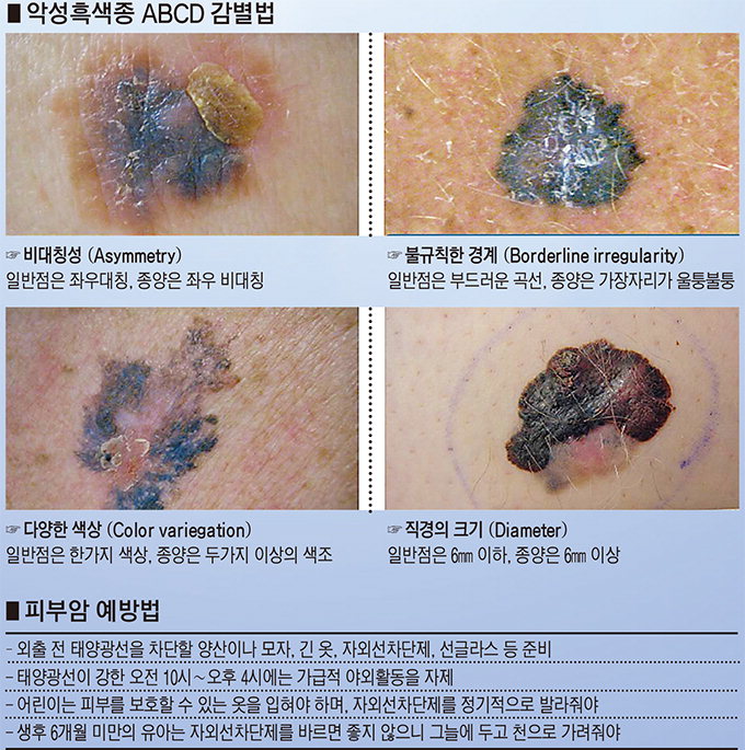 점인 줄 알고 방치…피부암, 자외선을 피하라