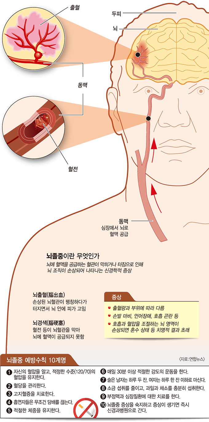 “두통·어지럼증 반복적으로 나타난다면 뇌졸중 의심”