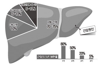 [전문의에게 듣는다] 간세포암 바로알기