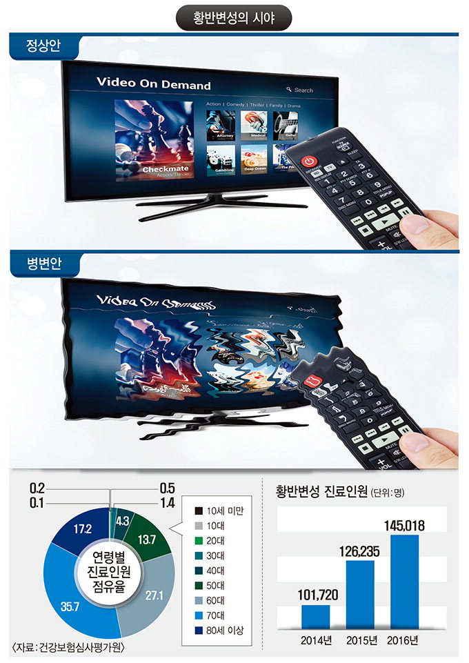 [전문의에게 듣는다] 황반변성 원인·증상