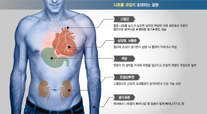 짜게 먹으면 소변으로 칼슘 빠져 ‘골다공증’ 위험 증가