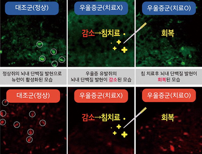 침으로 삼음교 혈자리 자극하면 갱년기 우울증 완화