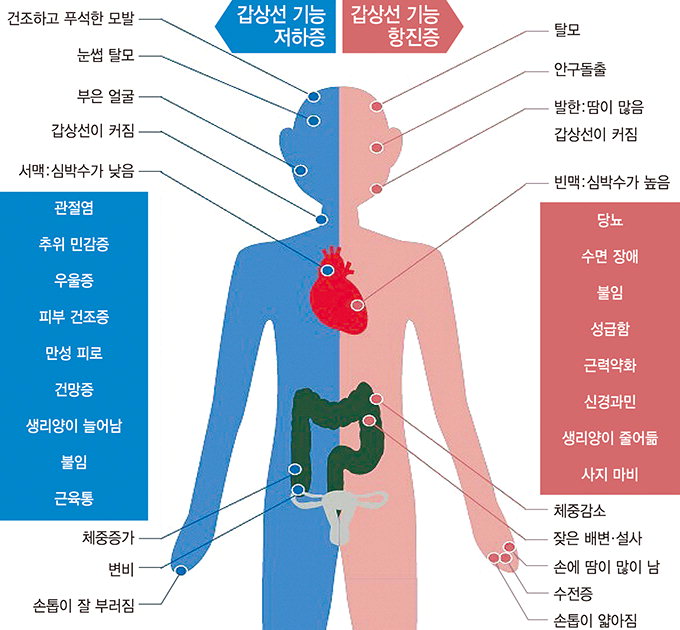 [전문의에게 듣는다] 갑상선 기능성 장애