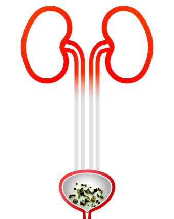 만성 신장병, 물조차도 과유불급