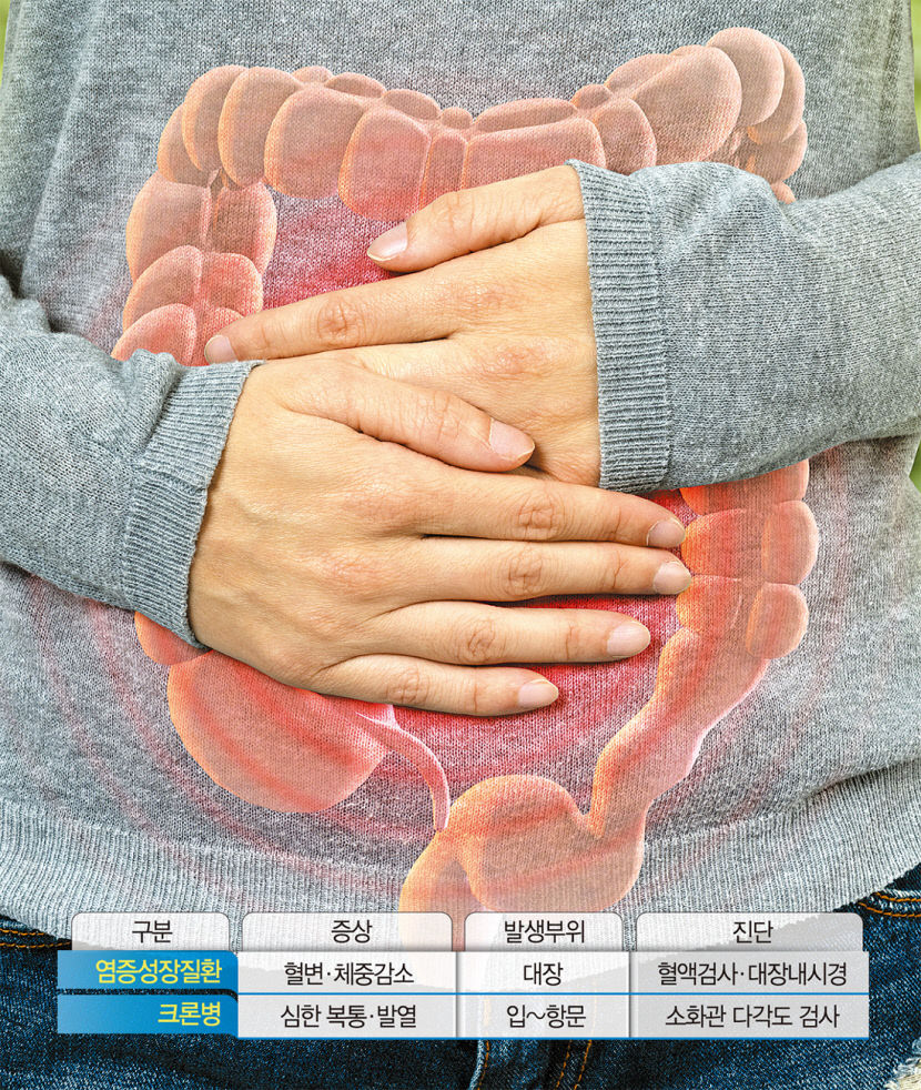 [전문의에게 듣는다] 염증성 장 질환…여름철 장염 증상 비슷, 방치땐 대장암 위험