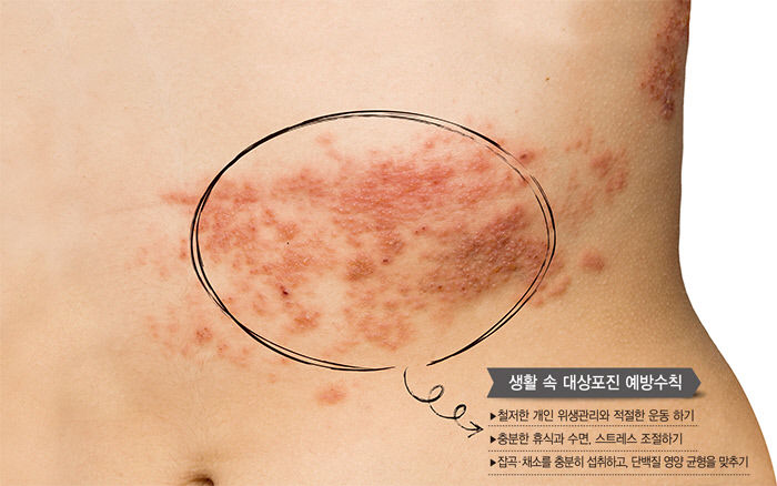 바람만 스쳐도 극심한 고통…대상포진 예방, 면역력 향상이 답