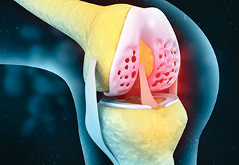 관절염 무릎 무릎 퇴행성