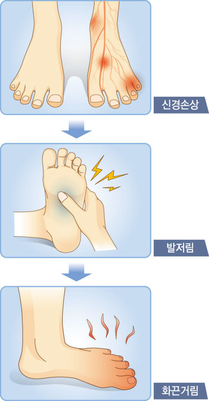 칼로 찌르는 듯한 통증, 저림·화끈거림 호소…발궤양, 1년내 30%가 재발…매일 관찰하는 습관이 중요