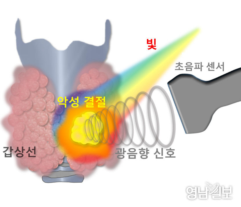 광음향 영상법 도입...갑상선 암 인공지능으로 진단한다
