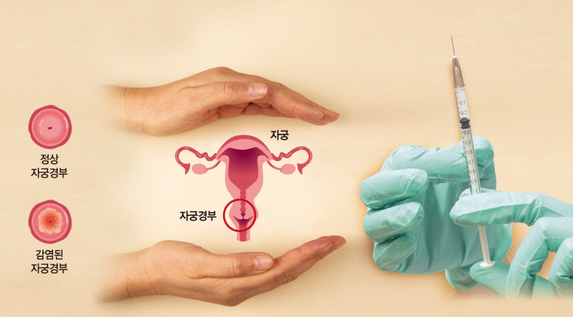 女암사망률 2위 자궁경부암…백신 맞으면 80% 예방 가능