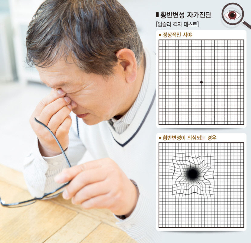 [전문의에게 듣는다] 늘어나는 젊은 황반변성 환자…시력 나빠지고 물체 찌그러져 보이면 즉시 검사 받아야