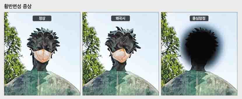 [전문의에게 듣는다] 황반변성…사물 구부러져 보이거나 중심 어둡게 보이면 의심