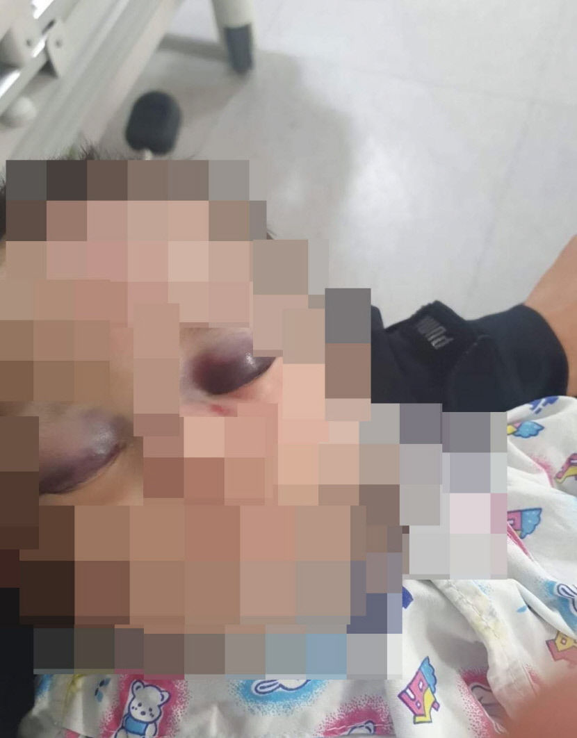 경북 구미에서 6개월 영아 아동학대 의심 사건 발생, 경찰 수사중