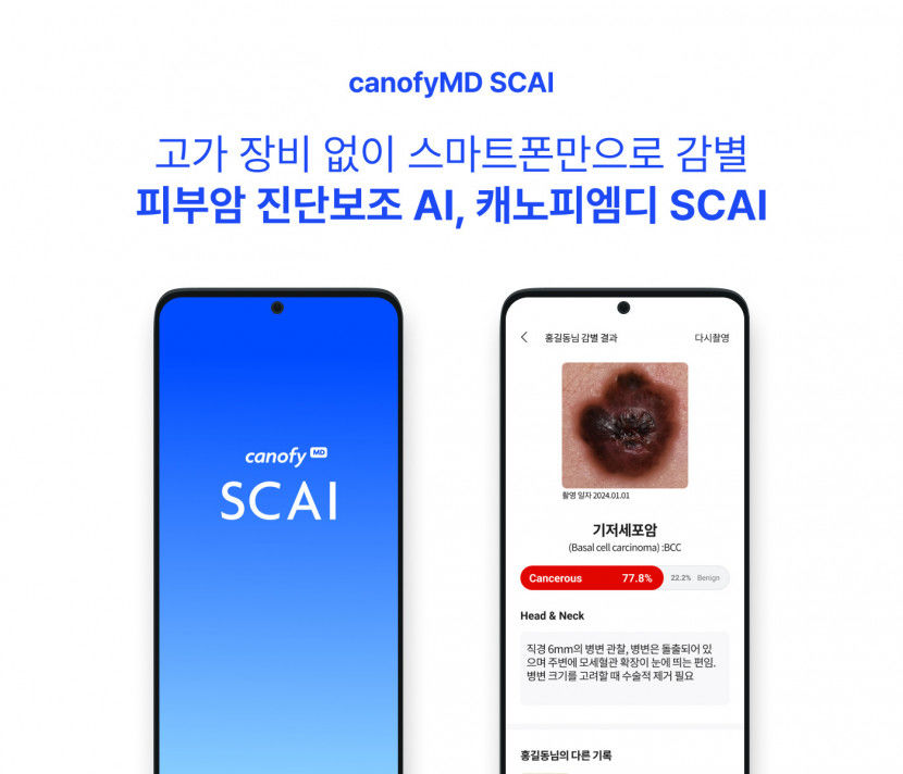 라이프시맨틱스, 피부암 진단 AI ‘캐노피엠디 SCAI’ 식약처 허가 신청