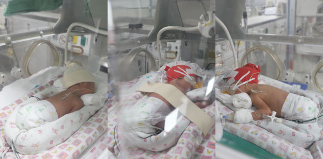 계명대 동산병원서 세쌍둥이 탄생…모두 남아 건강해