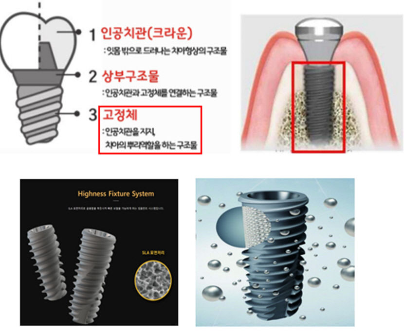 임플란트·웨어러블의료기기 등 대구기업 디지털헬스케어분야 산업 고도화 성과