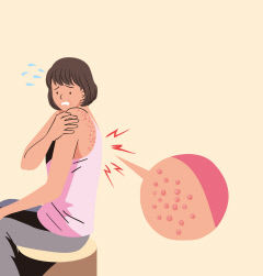 여름 복병 '대상포진', 숨어 있던 수두바이러스가 원인…면역력 저하시 발병 띠모양 물집