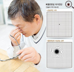 [전문의에게 듣는다] 늘어나는 젊은 황반변성 환자…시력 나빠지고 물체 찌그러져 보이면 즉시 검사 받아야
