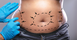 BMI 25→27로 비만기준 상향조정 해야 할 연구결과 나와