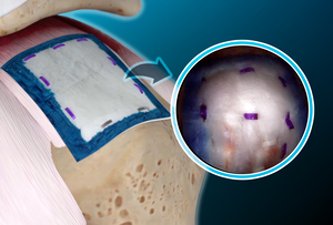 [의료특집]굳센병원, 대구경북 최초 ‘리제네텐’도입…회전근개 치료 새 이정표
